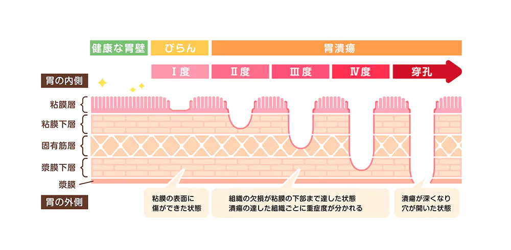 胃がんの進行度